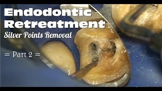 Endodontic Retreatment  Silver Points Removal Part 2 [upl. by Mossolb]