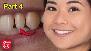 HOW TO Bond AllCeramic Crown for Peg Lateral Tooth 10 [upl. by Ted]