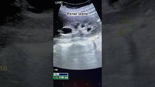 Kidney stoneRenal stoneUreteric stone stone kidney ultrasound reels shorts ultraradiology [upl. by Liddy]