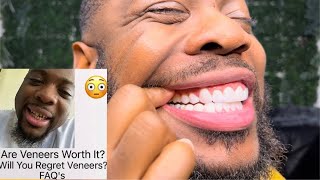 3 Year Veneer Update Dr Gonzaga Taberez  100 Porcelain Veneers [upl. by Juxon]