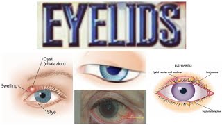 Eyelids 5 Minor Topic Phthiriasis PalpebrumTrichiasis [upl. by Wan]