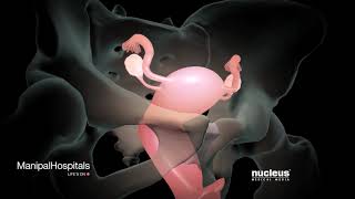 How Is A Robotic Hysterectomy Done  Robotic Hysterectomy Surgery  Gynaecology  Manipal Hospitals [upl. by Youngran]