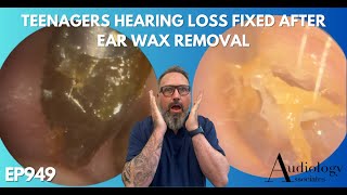 TEENAGERS HEARING LOSS FIXED AFTER EAR WAX REMOVAL  EP949 [upl. by Ainesej]