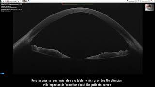 Anterior Segment OCT  MS39 [upl. by Yerdua]