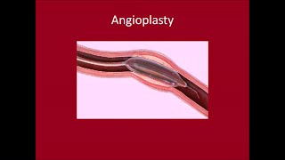 Angioplasty [upl. by Kcid716]