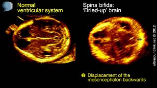 Spina bifida 3D ultrasound diagnosis at 1113 weeks [upl. by Teiv166]