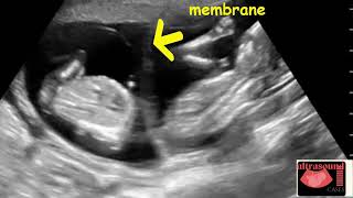 Monochorionic Twins at 9 Weeks Ultrasound Cases [upl. by Ettenal]