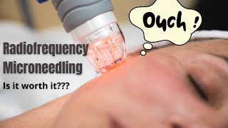 Radiofrequency Microneedling  Does it actually work  Dermatologist reviews [upl. by Magnum]