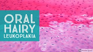 Oral Hairy LeukoplakiaExplained by a Dermatopathologist [upl. by Nosduj]