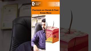 PSORIASIS on Hands amp Feet Palmoplantar Psoriasis TreatmentDrRajdeep MysoreDoctors Circleshorts [upl. by Assirek]