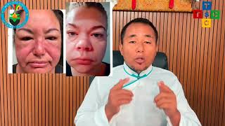 སྐྱ་རྦབ་ནད་བཅོས་ཐབས།་ EDEMA treatment [upl. by Zurek]