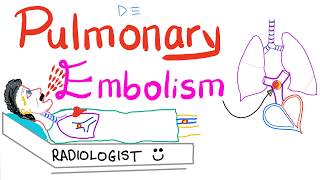 Pulmonary Embolism PE  Causes Symptoms Signs Diagnosis amp Treatment  Respiratory System [upl. by Nibot]