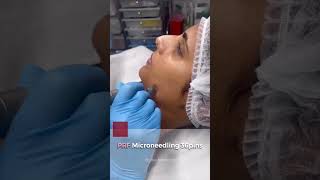 Bio Filler PRF Gel under eyes treatment [upl. by Aeuhsoj719]