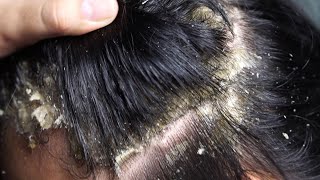 Dandruff scratching removal on head using black combing229 [upl. by Sutherland]