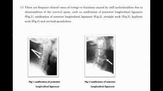 An alternative interpretation of “Benign Paroxysmal Positional Vertigo” [upl. by Nrubua496]