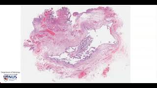 Fallopian tube  Hydrosalpinx microscopy  Talking slide [upl. by Etnwahs]