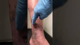 RECURRENT VENOUS LEG ULCERS [upl. by Rego]