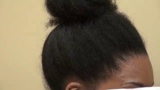 African American Hair Restoration Surgery Result Hairline Lowering Dr Diep wwwmhtacliniccom [upl. by Okim703]