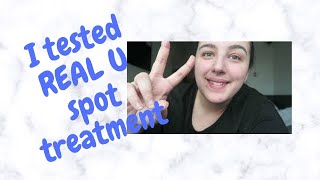 The Real U spot treatment  Review [upl. by Farman]