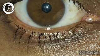 Eyelid myokymia CC99 [upl. by Inattyrb433]