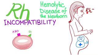 Rh incompatibility and Hemolytic disease of the newborn HDN [upl. by Enilekaj]