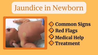 “Why Do Newborns Turn Yellow Understanding Jaundice in Babies” baby newborn newparentsguide [upl. by Emelyne]