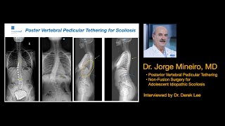 Dr Jorge Mineiro MD on Posterior Vertebral Pedicular Tethering a NonFusion Scoliosis Treatment [upl. by Doretta]