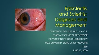 Scleritis and Episcleritis Vincent de Luise MD [upl. by Gui]