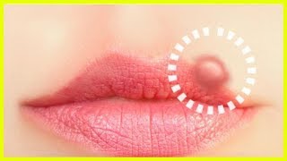 10 Naturheilmittel gegen Lippenherpes [upl. by Nessaj]