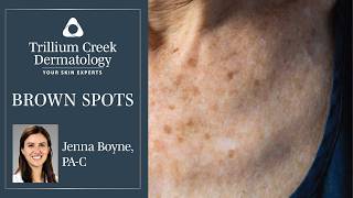 What are those Brown Spots on your skin [upl. by Avuha]