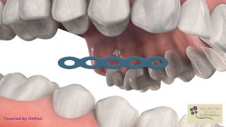 TAD for OverErupted Molar  Wellington Village Orthodontics [upl. by Mireille]