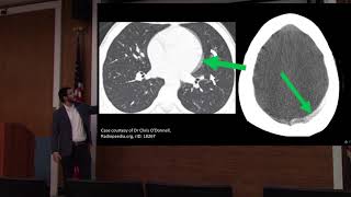 Dr Adam Blumenberg Artifacts in CT Scans [upl. by Ssur]