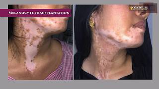 Melanocyte Transplantation  Vitiligo  Leukoderma Treatment  Dr Venkata Ramana Yamani  Contours [upl. by Sherlocke]