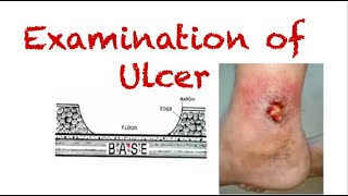 Examination of Ulcer  A guide for surgical case evaluation [upl. by Ainelec505]