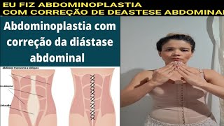 Fiz CORREÇÃO de diástase Com ABDOMINOPLASTIA abdominoplastia [upl. by Grannia149]