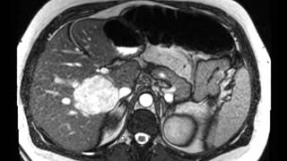 Liver Hemangioma [upl. by Card]