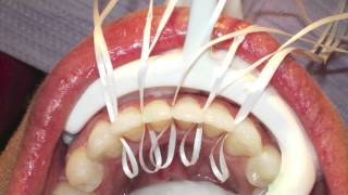 Retanium Splint Placement Orthodontics [upl. by Jethro196]