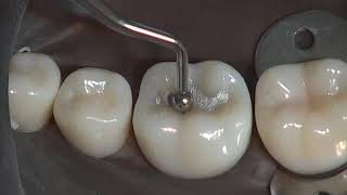 Class I Amalgam Preparation amp Restoration  Operative Dentistry [upl. by Gilmour]