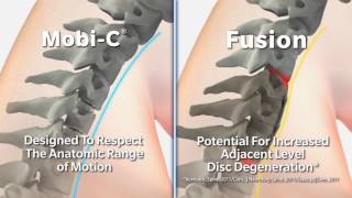 Mobi C vs fusion movement in neck [upl. by Seena]