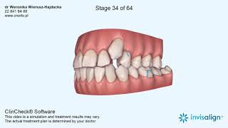 Aparat ortodontyczny Invisalign  wizualizacja leczenia dr Weronika WieruszHajdacka [upl. by Berkin]