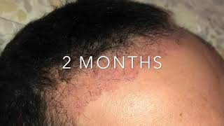 Trapianto Capelli Giorno per Giorno da giorno 1 a 6 mesi  Hair transplant Day By Day [upl. by Hallutama990]