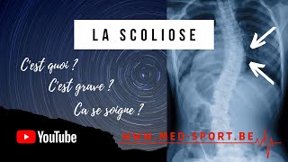 Comment lutter contre une scoliose [upl. by Auqenahc]