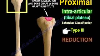 Tibial Plateau Fracture Fixation Proximal Tibia  Everything You Need To Know  Dr Nabil Ebraheim [upl. by Ner]