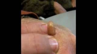 Man Squeezes Botfly from Hand [upl. by Apicella832]