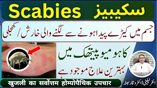 Scabies شدید خارش اور کھجلی शरीर में कीड़ों से खुजली होना Homeopathic Treatment In Urdu  Hindi [upl. by Anoit996]