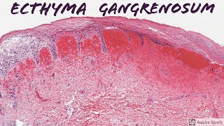 Ecthyma Gangrenosum 5Minute Pathology Pearls [upl. by Ainavi]