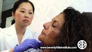 Sculptra to combat collagen deflation in the cheeks [upl. by Anipsed]