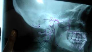 puntos y trazos en cefalometria [upl. by Llehsor]