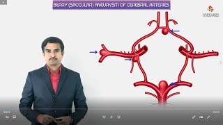 Berry aneurysms saccular  Most common sites Symptoms Diagnosis and Pathology [upl. by Chouest342]