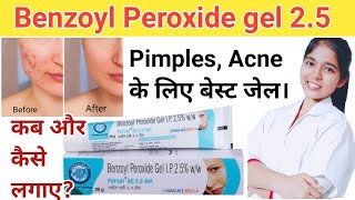 Persol AC 25 GEL  Pimple Acne ka ilaj  Benzoyl peroxide gel  DrxPranjali Satpute [upl. by Yulma961]